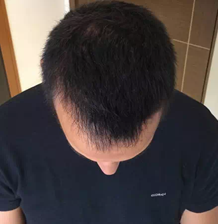 Prevent Hair Loss Best Supplement